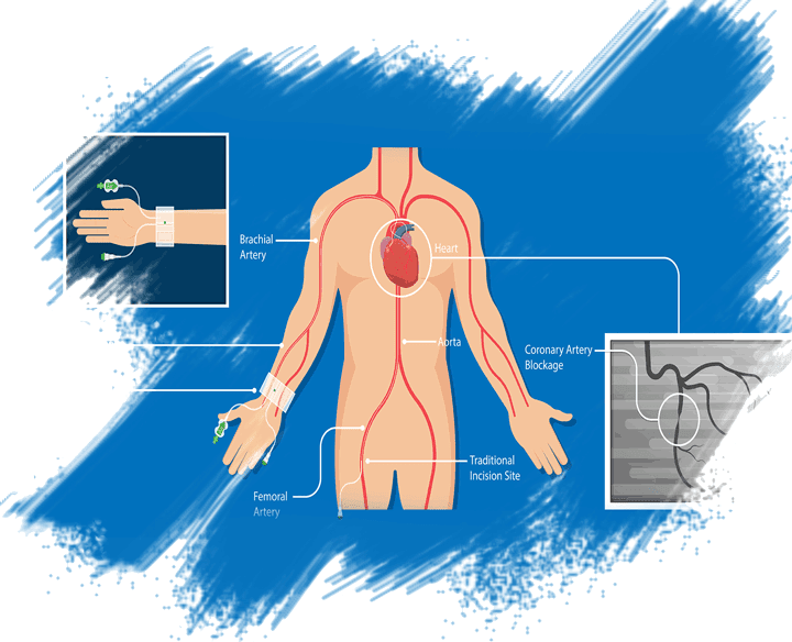 Need CORONARY ANGIOGRAPHY?