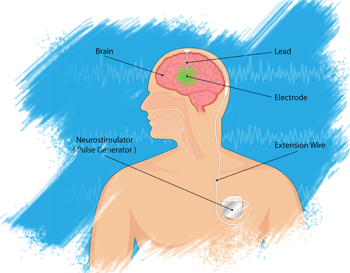 Looking for DEEP BRAIN STIMULATION?