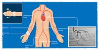 
Coronary Angiography
