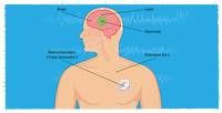 
Deep Brain Stimulation
