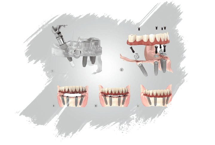Looking for DENTAL IMPLANTS