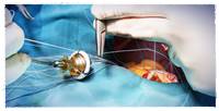 Heart valve replacement