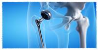 
Hip Replacement Surgery
