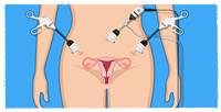 
Hysterectomy Treatment
