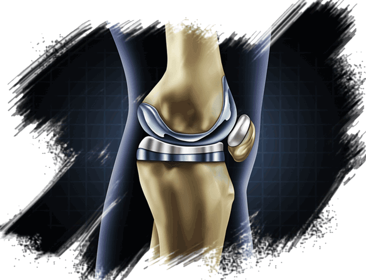 Looking for KNEE REPLACEMENT OPERATION?