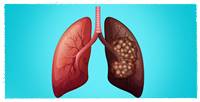 
Lung Cancer Treatment
