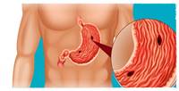 
Stomach Cancer Treatment
