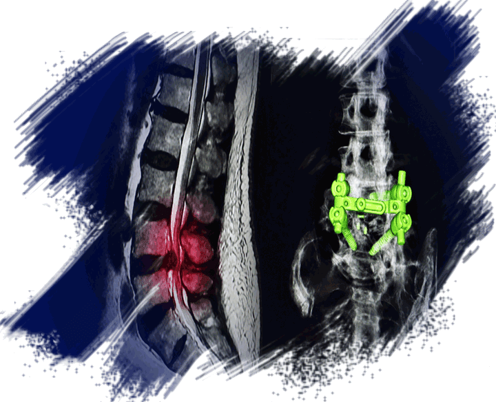 Looking for
Transforaminal Lumbar Interbody Fusion (TLIF)?
