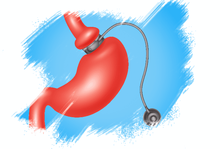 Looking for LAPAROSCOPIC GASTRIC BANDING?