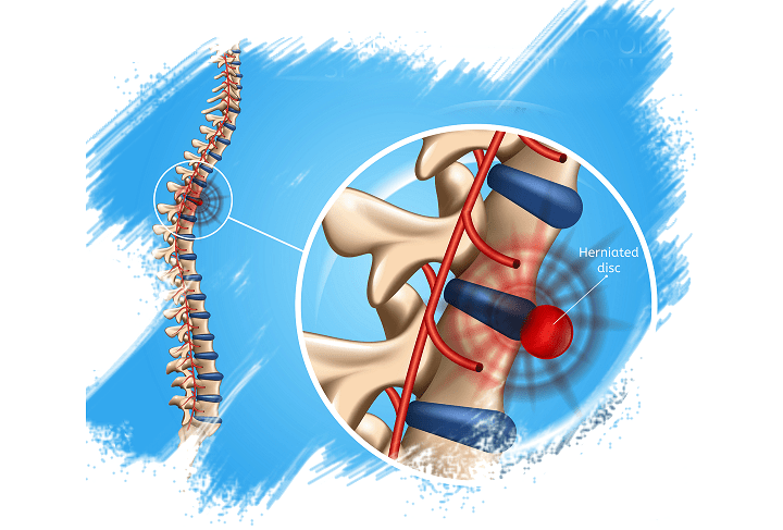 Looking for MICRODISCECTOMY?